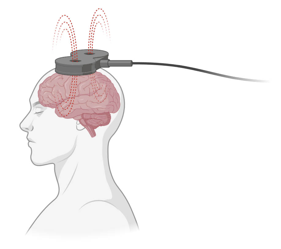 neuromodulación, estimulación, magnética, transcraneal